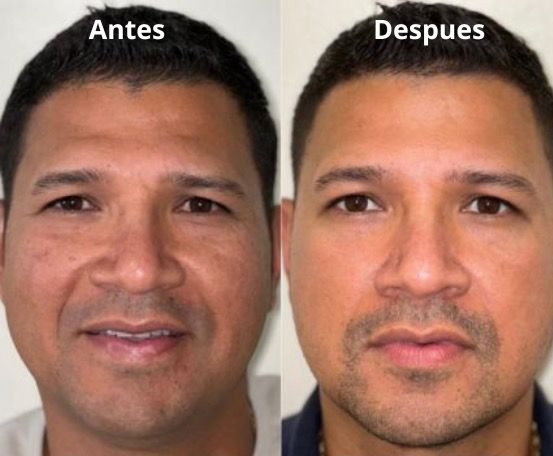 Colágeno Eelhoe Crema Anti-edad - Antiarrugas 2X1